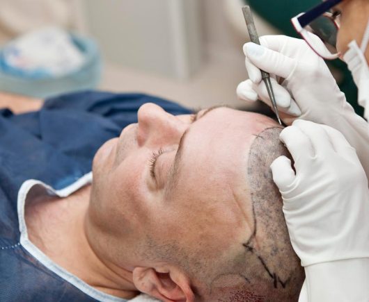 Hair Transplant